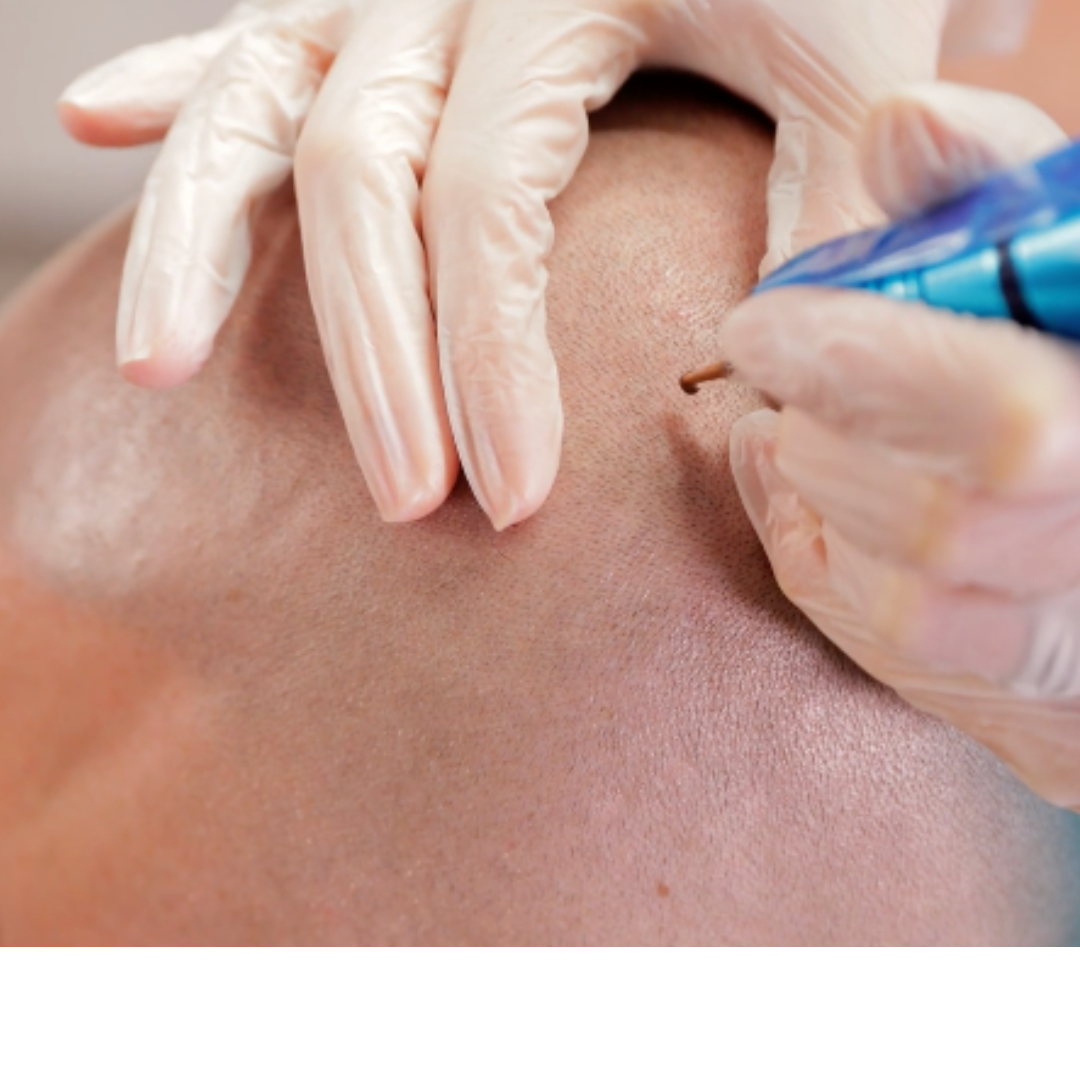 Scalp Micropigmentation (SMP)